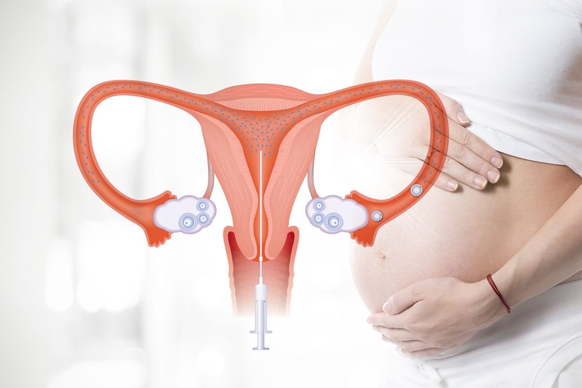 What Is ICSI Fertility Treatment? Complete Guide
